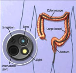 colonoscopy image