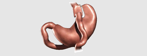 gastric img