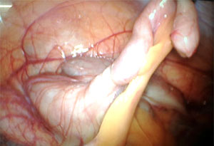 lap Appenductomy img