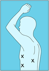 thoracoscopy image